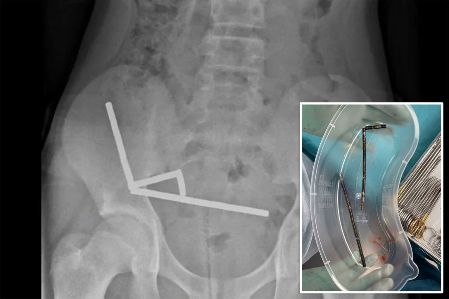 13yearold boy has emergency surgery after swallowing 100(01)
